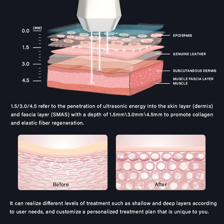 NoTime HI-FUN Pro - Superior HIFU Technology