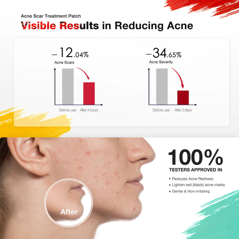 JOVS Acnebye - Acne and Blemish Remover